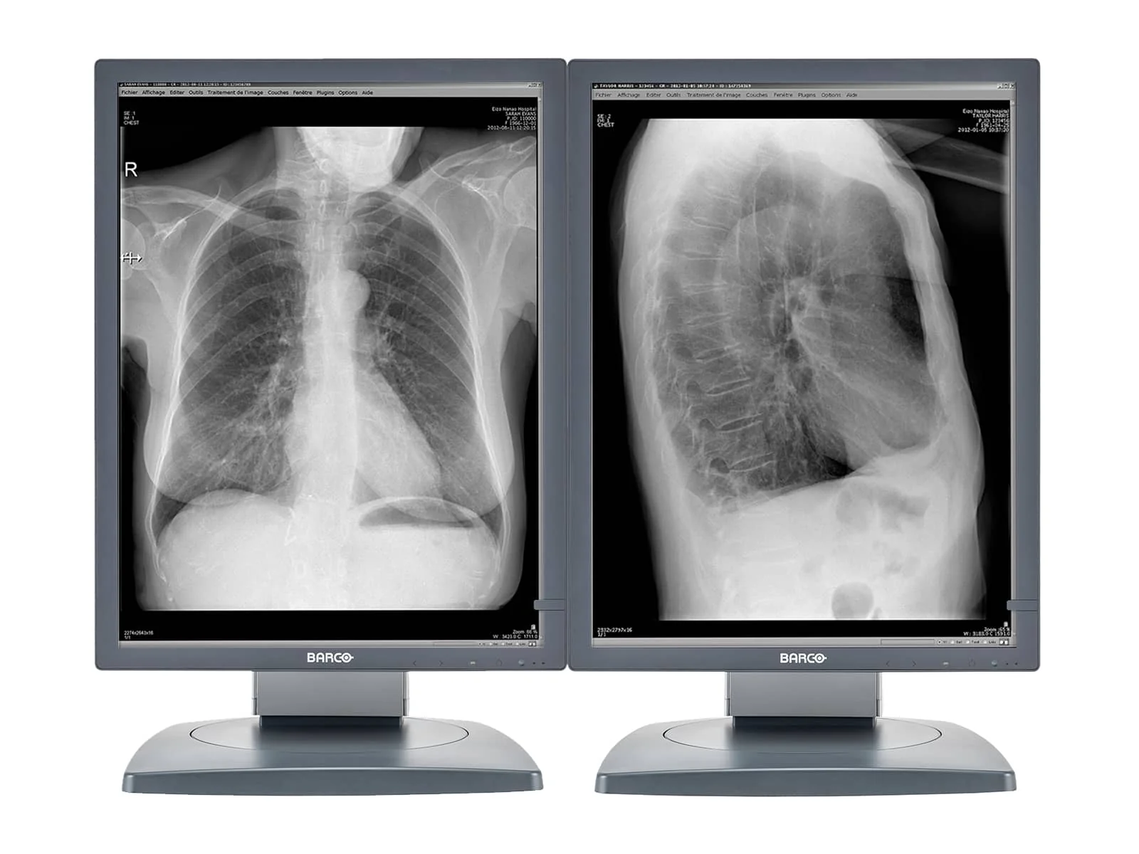 Barco Coronis MDCG-3120 3MP 20.8" Grayscale General Radiology Diagnostic Display