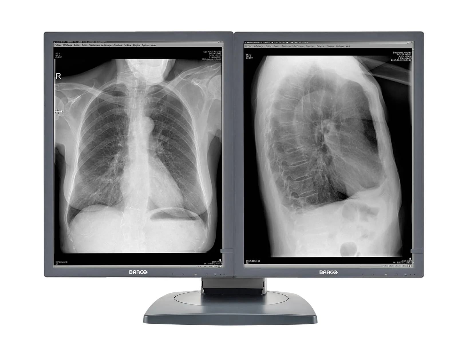 Barco Coronis MDCG-3120 3MP 20.8" Grayscale General Radiology Diagnostic Display - Image 3