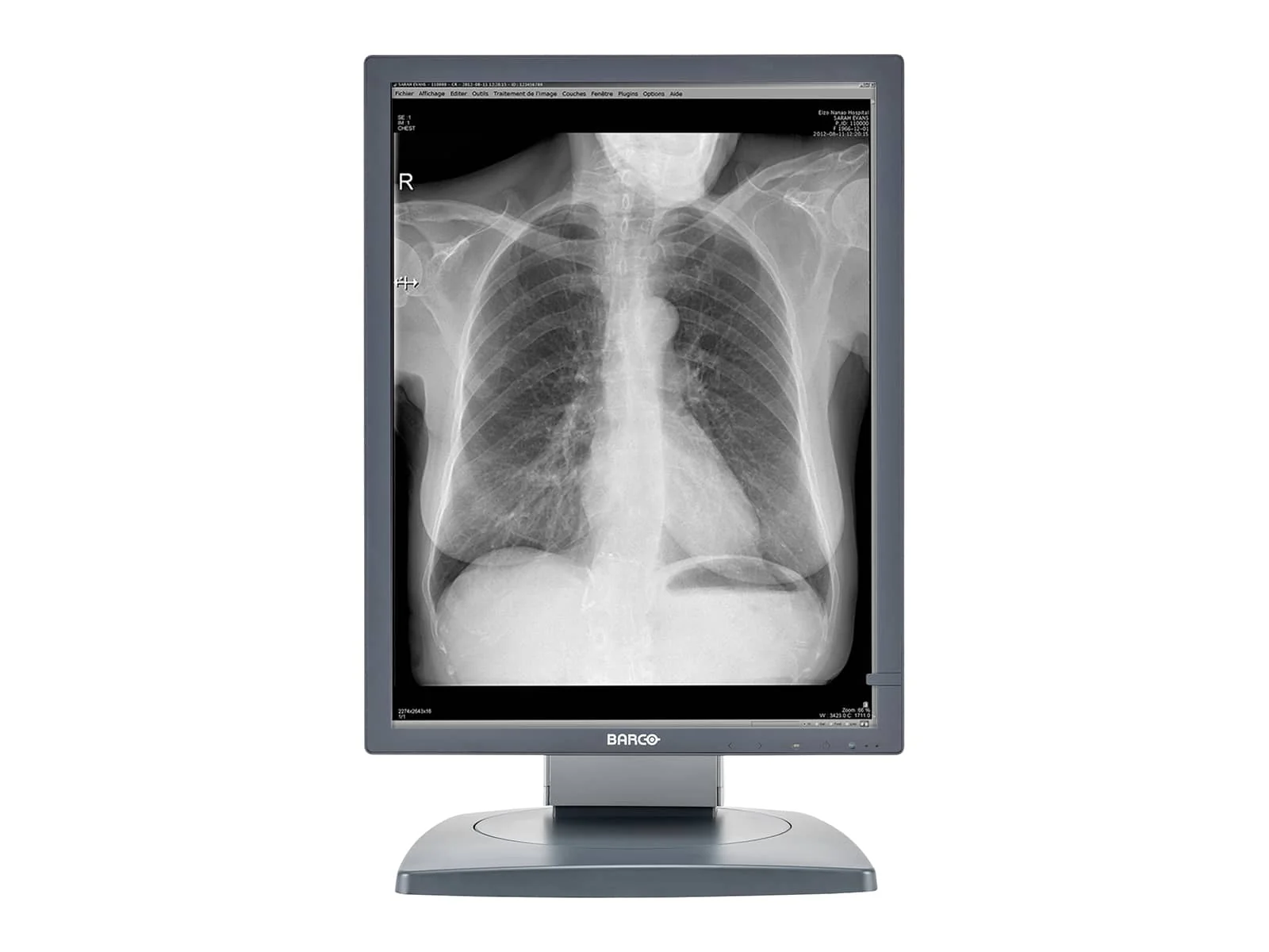 Barco Coronis MDCG-3120 3MP 20.8" Grayscale General Radiology Diagnostic Display - Image 5
