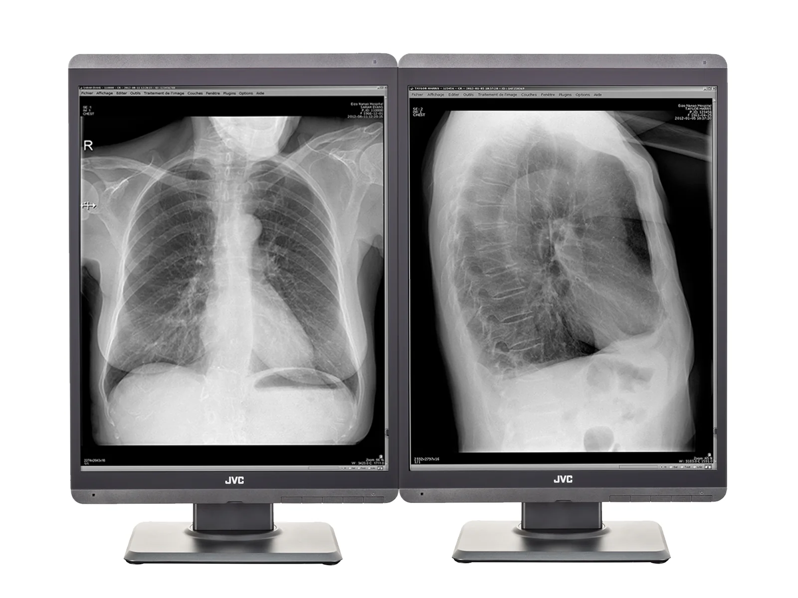 JVC Totoku MS-S200 2MP 21" Grayscale Diagnostic Radiology Display Monitor (MS-S200)
