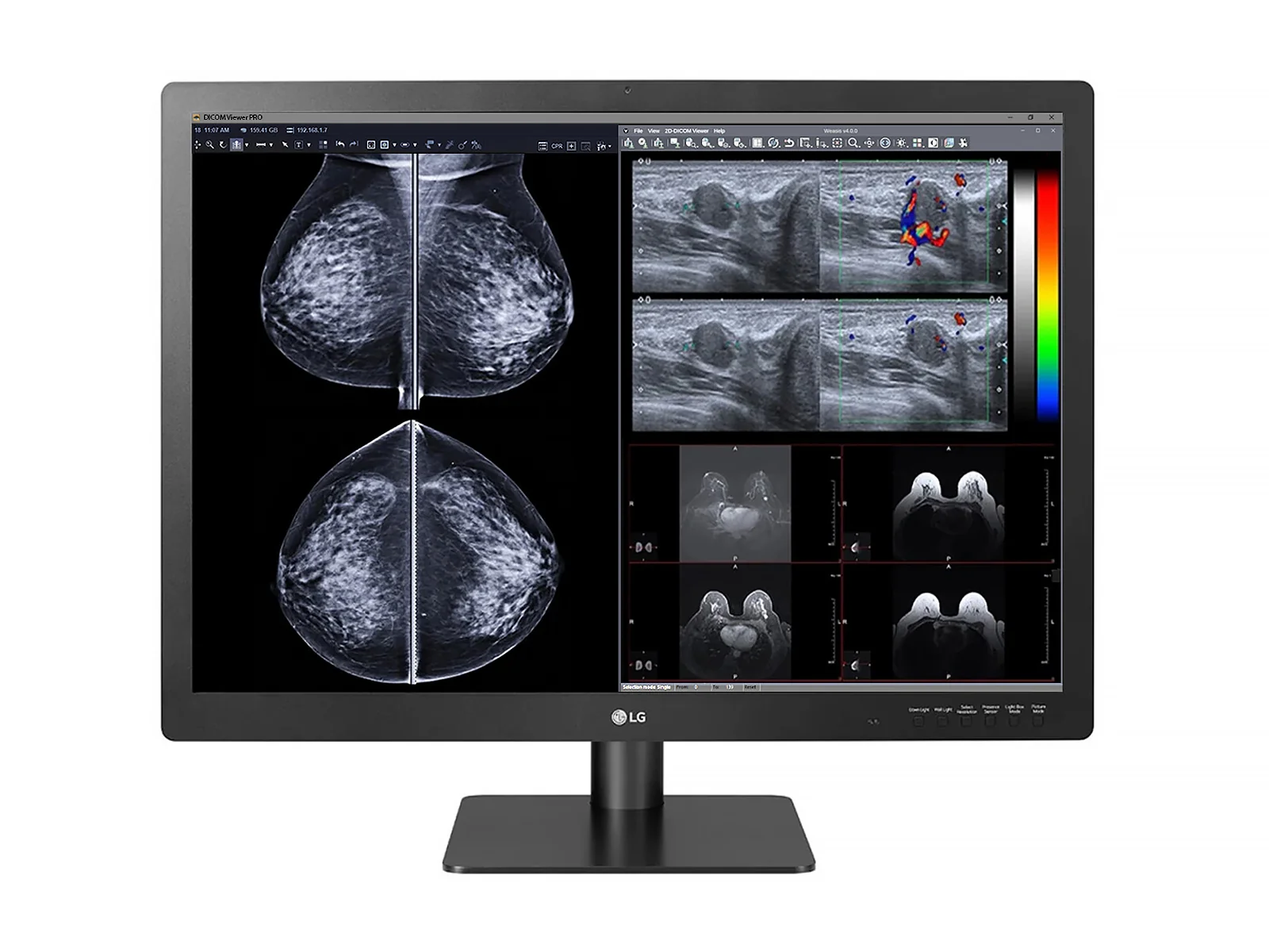 LG 12MP Fusion 31.5" 31HN713D-B Color Mammography 3D-Tomosynthesis Breast Imaging Display